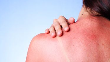 Как проявляется аллергия на солнце и чем лечить?