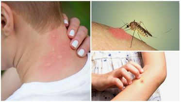 Как лечить комариные укусы у детей и взрослых?